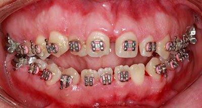 Gingivectomy Roseville Case Study 2