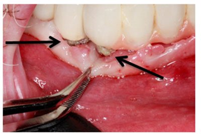 Gingivectomy Roseville Case Study 4