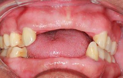 Gingivectomy Roseville Case Study 5
