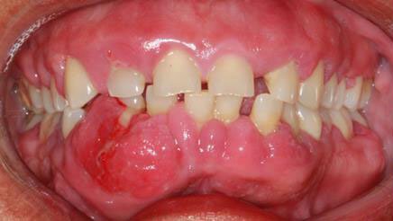 Gingivectomy Roseville Case Study 6
