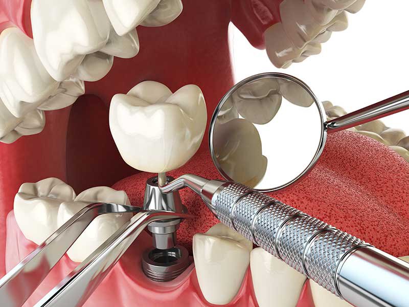Dental Implants Roseville