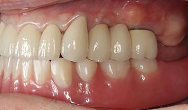 Roseville Missing Teeth Treatment Case Study 1