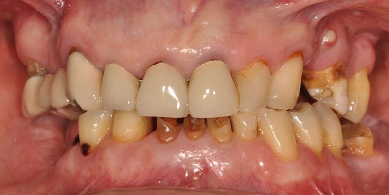 Roseville Missing Teeth Treatment Case Study 2