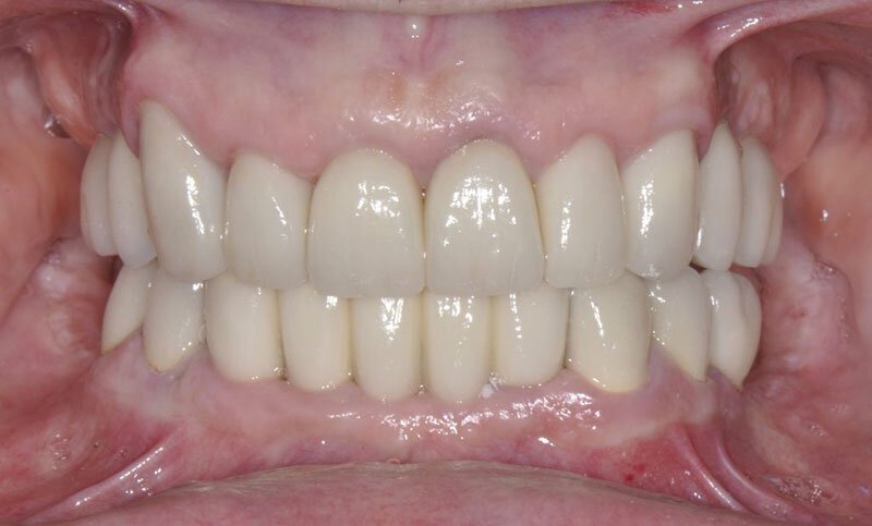 Roseville Missing Teeth Treatment Case Study 2