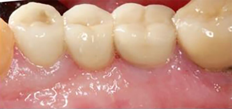 Roseville Missing Teeth Treatment Case Study 3