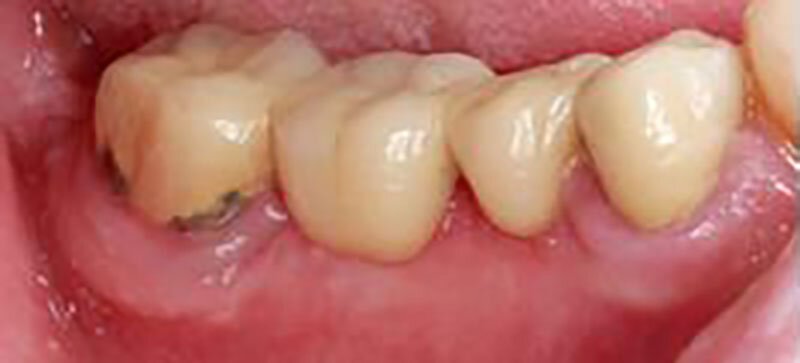 Missing Teeth Treatment Case Study 3