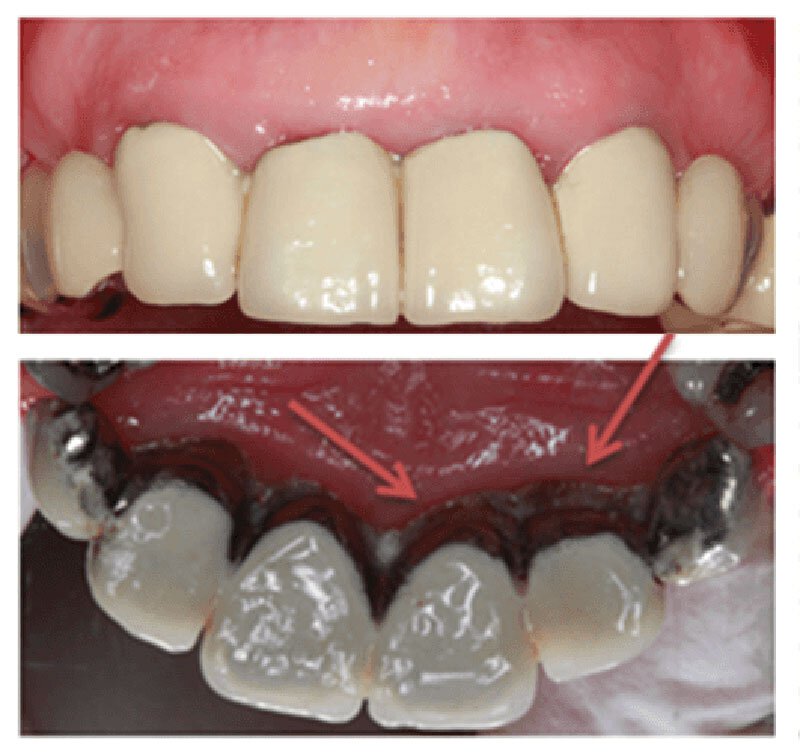 Periodontitis Roseville Treatment Case Study Teeth 1