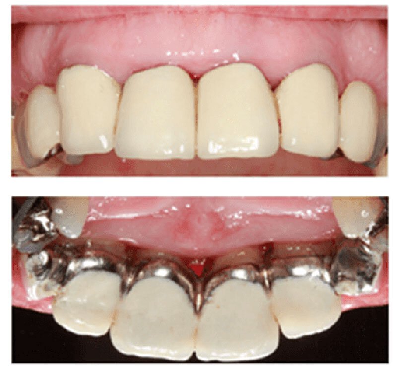 Periodontitis Roseville Treatment Case Study 1 After