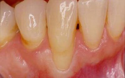 Gum Recession Treatment Case Study 3