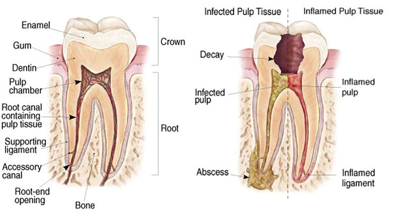 Root Canal Therapy Roseville