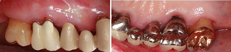 Surgical Dental Treatment Roseville Case Study 2