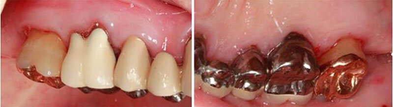 Surgical Dental Treatment Roseville Case Study 3