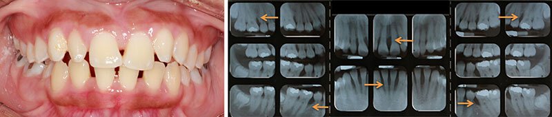 Surgical Dental Treatment Roseville Regenerative Case Study