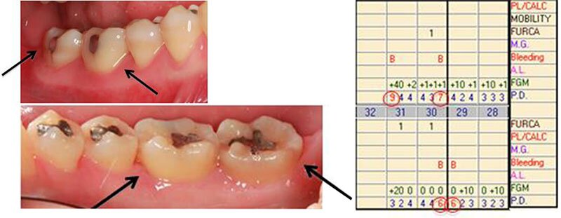 Surgical Dental Treatment Roseville Regenerative Case Study 2