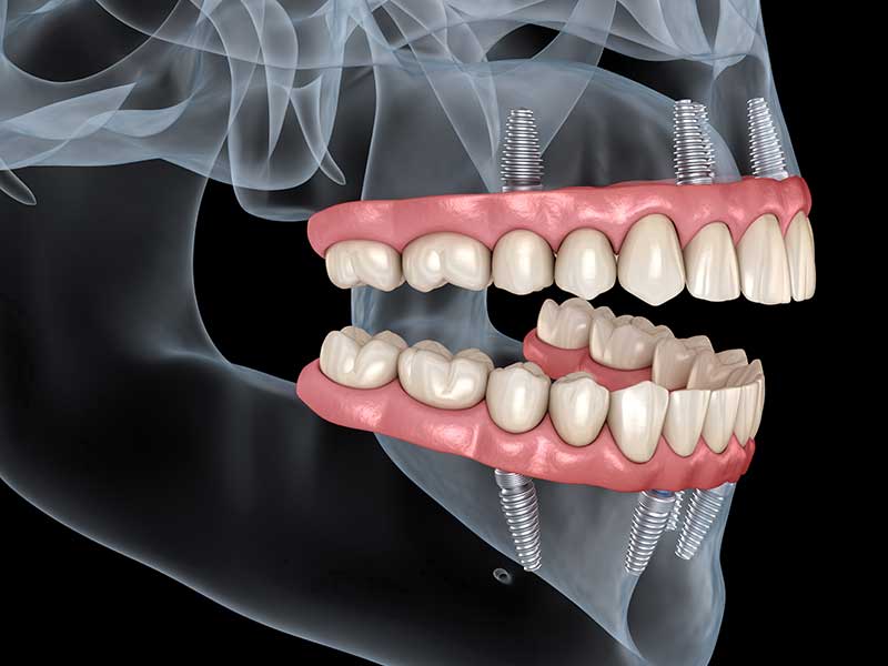 All on Four Dental Implants Roseville