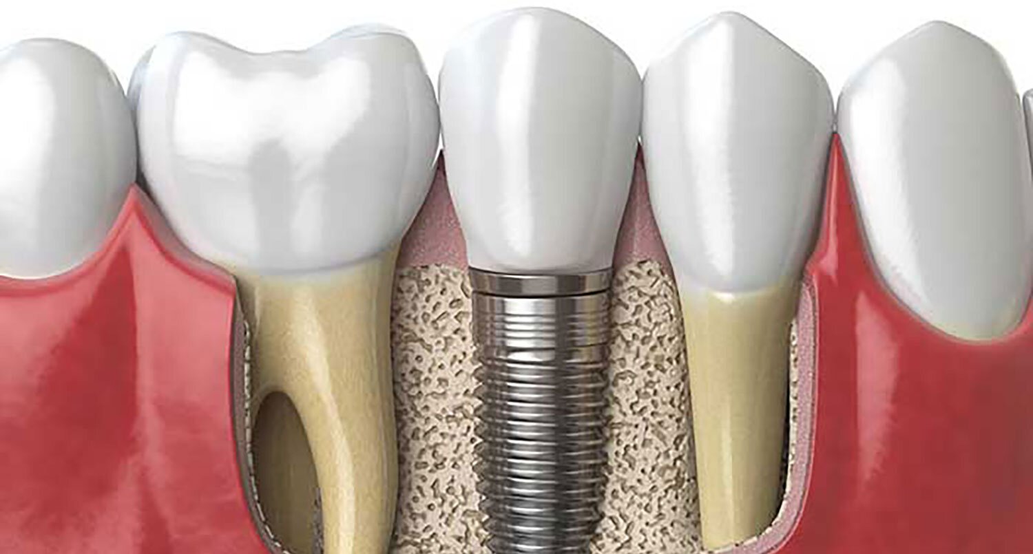 dental implants Blog
